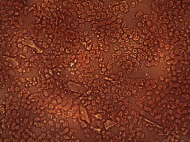 damaged blood cell 3