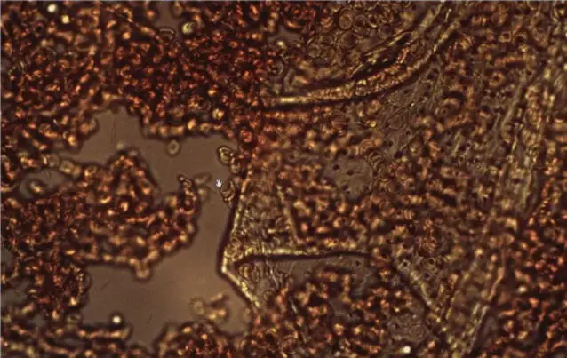 damaged blood cell 2